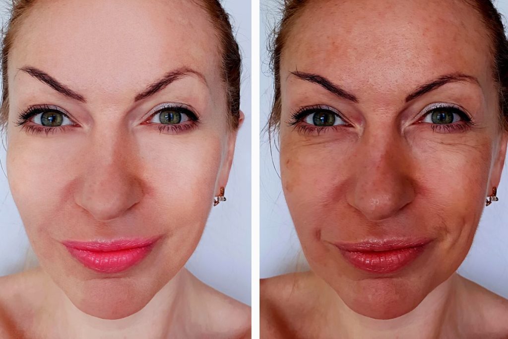 rf microneedling before and after treatment